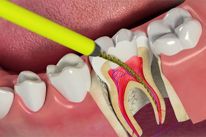 root canal treatment in thoraipakkam
